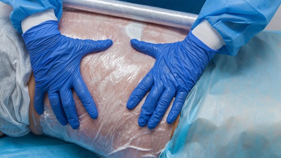 Nouvelles techniques mini-invasives en chirurgie bariatrique