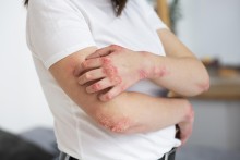 Patiente atteinte de psoriasis en plaques sur les avant-bras