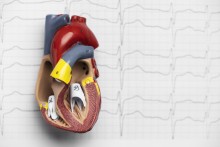 Prévention Primaire des Maladies Cardiovasculaires : Une Réflexion Basée sur une Expérience Personnelle et le Rôle Clé du Coro Scanner